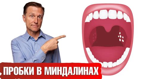 Причины возникновения гнойных шариков на гландах