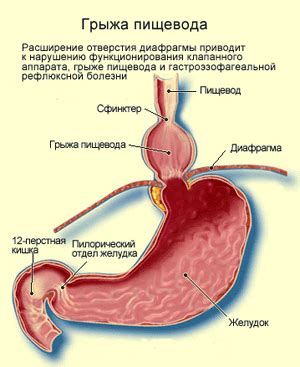 Причины возникновения грыжи пищевода