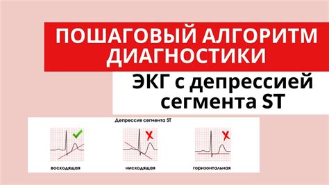 Причины возникновения депрессии сегмента ST на ЭКГ