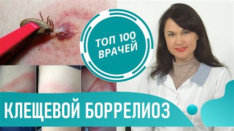 Причины возникновения лайм-боррелиоза