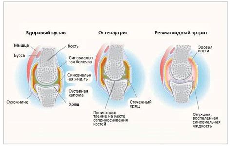 Причины возникновения менископатии коленного сустава