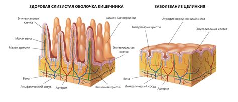 Причины возникновения непереносимости галактозы