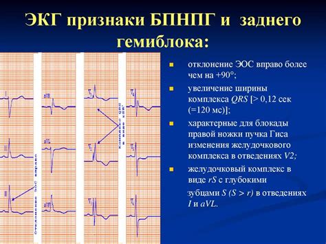 Причины возникновения неполной блокады правого пучка Гиса