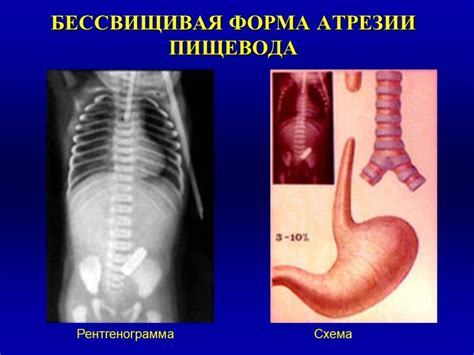 Причины возникновения непроходимости пищевода