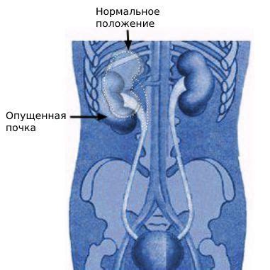 Причины возникновения обструкции обеих почек