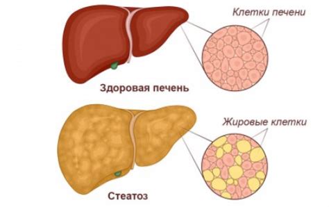 Причины возникновения ожирения печени