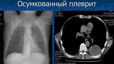 Причины возникновения осумкованного плеврита