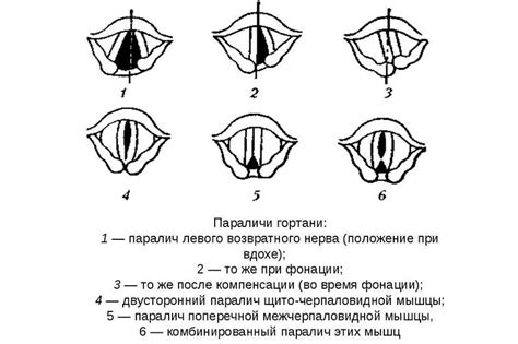 Причины возникновения пареза гортани