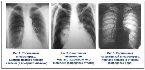 Причины возникновения пневматизации легкого