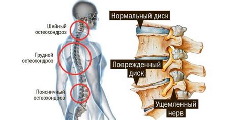 Причины возникновения поясничного остеохондроза