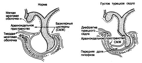 Причины возникновения пустого пшика