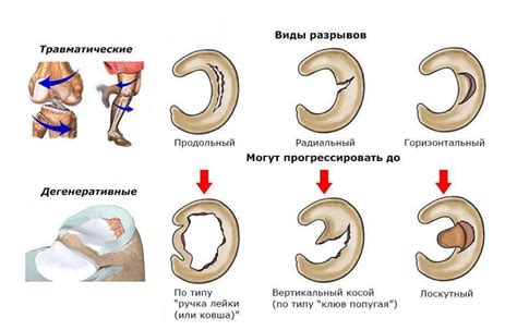 Причины возникновения разрывов мениска