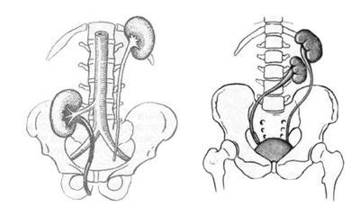 Причины возникновения ротации почек