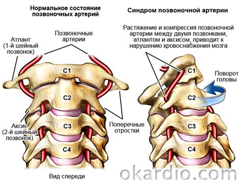 Причины возникновения синдрома позвоночной артерии