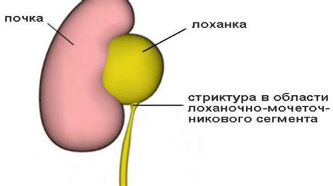 Причины возникновения цистоидного мочеточника