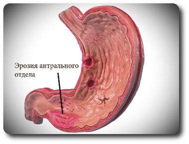 Причины гиперемии слизистой оболочки антрального отдела желудка