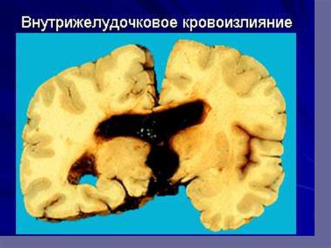 Причины гипоксического поражения ЦНС у новорожденных