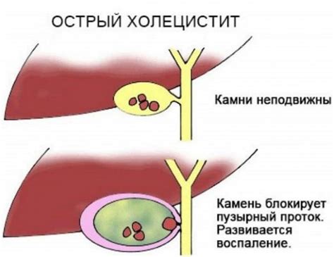 Причины гипотонического желчного пузыря