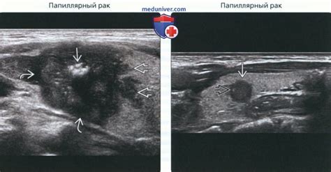 Причины гипоэхогенного ободка