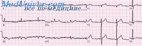 Причины изменения миокарда боковой стенки левого желудочка