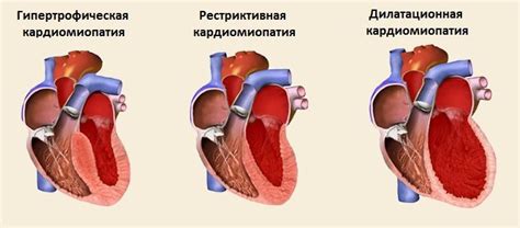 Причины и последствия вторичной кардиомиопатии