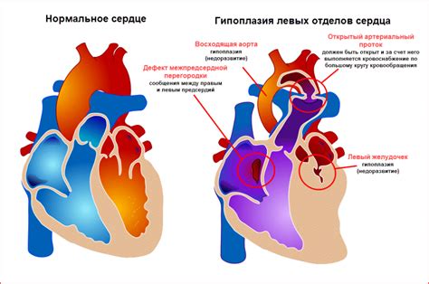 Причины и симптомы увеличения левых отделов сердца