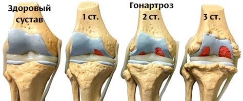 Причины и способы лечения выпадающего колена