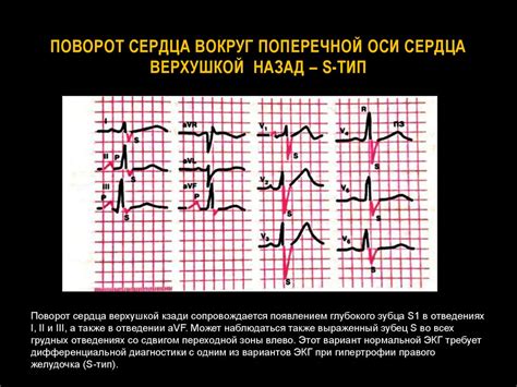 Причины и факторы риска поворота сердца верхушкой кзади на ЭКГ