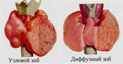 Причины коллоидного зоба с кистозной дегенерацией