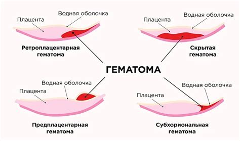 Причины кровянистых выделений при акте дефекации и способы лечения