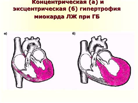 Причины левого расширения границы сердца