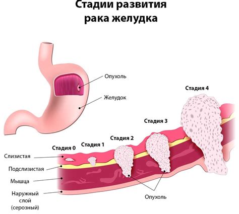 Причины лимфоидной инфильтрации желудка