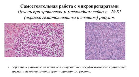 Причины лимфоидной инфильтрации стромы опухоли 10 процентов