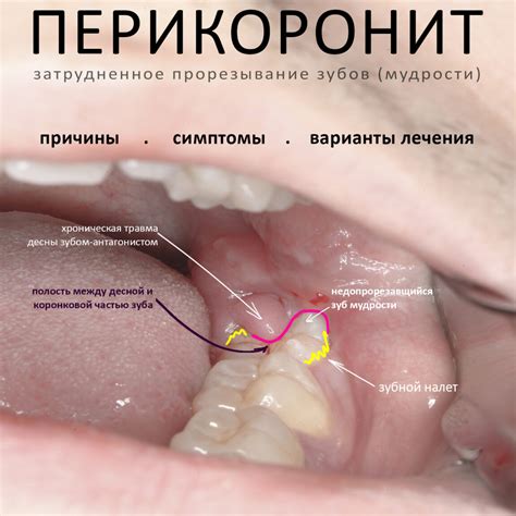 Причины метафизической потери зубов мудрости во время сновидений