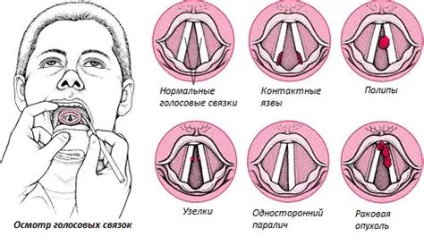 Причины надрыва голосовых связок