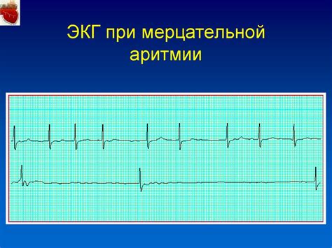 Причины небольшой аритмии на ЭКГ