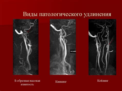 Причины невизуализации левой задней соединительной артерии и их значение