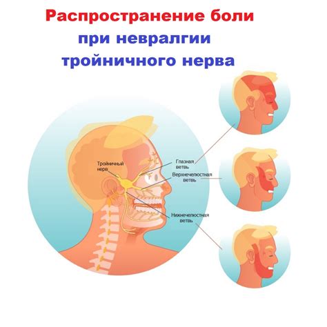 Причины невралгии тройничного нерва