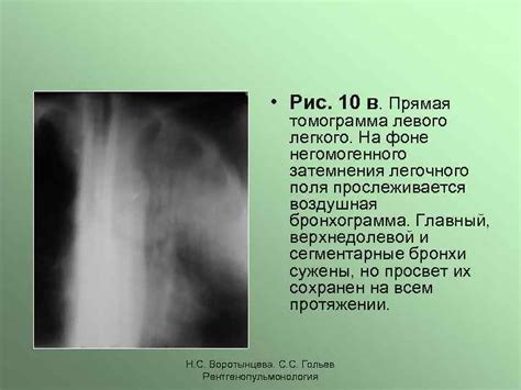 Причины негомогенного затемнения