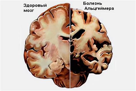 Причины недержания мочи при болезни Альцгеймера