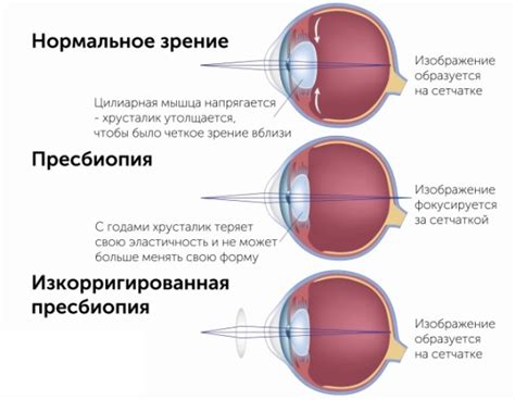 Причины недостаточной дальнозоркости