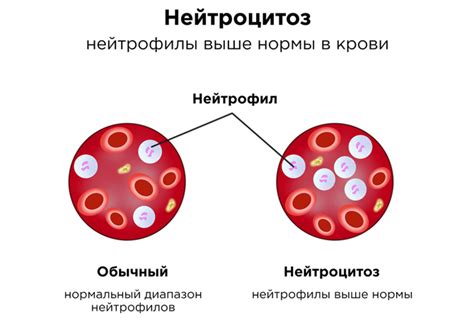 Причины нейтропении у детей