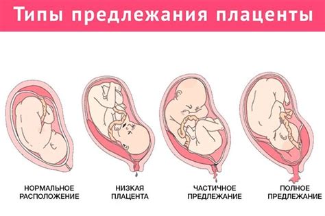 Причины неполного предлежания хориона