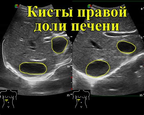 Причины неровных контуров печени на УЗИ