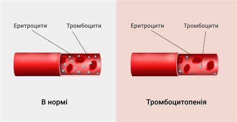 Причины низких тромбоцитов у взрослых