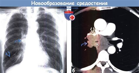 Причины новообразования в средостении