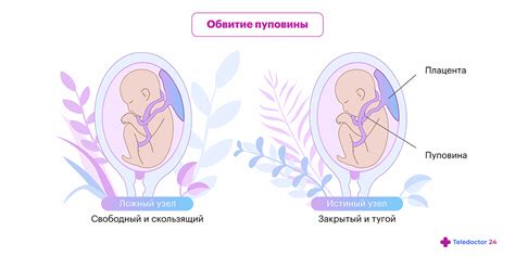 Причины обвития пуповиной