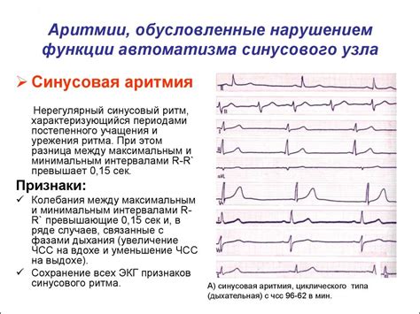 Причины обнаружения неравномерной сердечной ритма