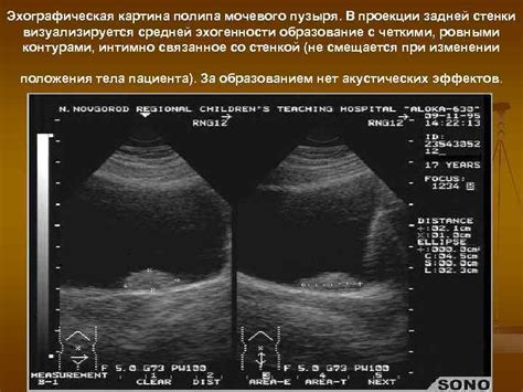 Причины образования средней эхогенности