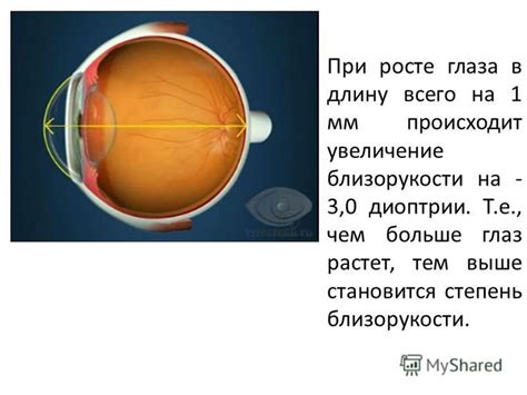 Причины отсутствия реакции глаза на диоптрии